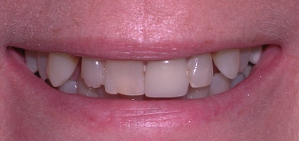 Dark and worn front teeth