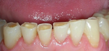 Severely worn bottom teeth