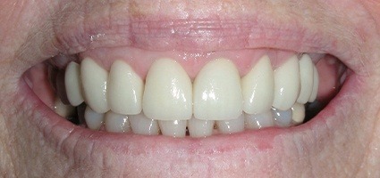 Beautiful smile after gingival recontouring