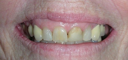 Gummy smile before treatment