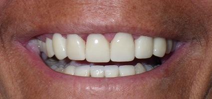 Gorgeous smile after gingival recontouring