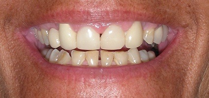 Stubby teeth before treatment