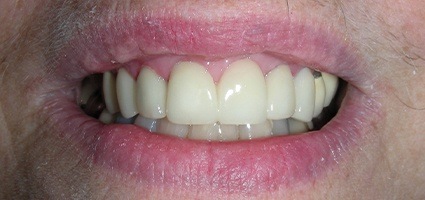 Perfected smile after gum recontouring