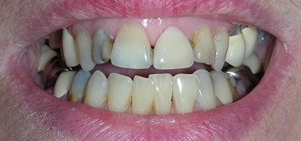 Damaged teeth and inflamed gums