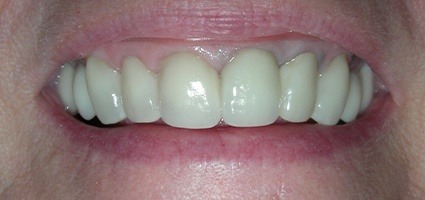 Healthy pink gum tissue after gingival recontouring