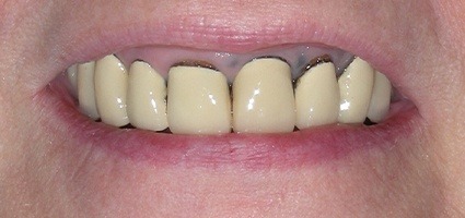 Dark coloring at gum line