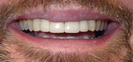 Replaced top canine teeth