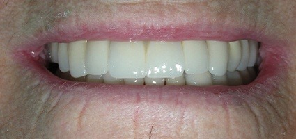 Smile with restorations on dental implants