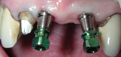 Smile with dental implant posts visible