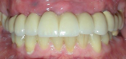 Replaced row of top front teeth