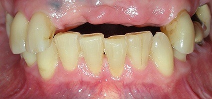 Missing row of top front teeth