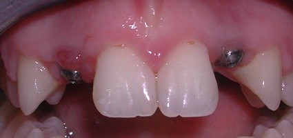 Missing top teeth with implant posts in place