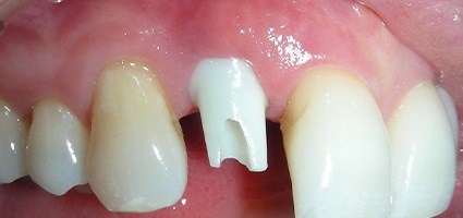 Smile with tooth-colored implant post