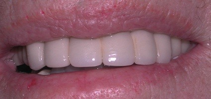 Natural looking restoration attached to implants