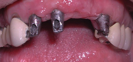 Three metal dental implant posts visible in smile