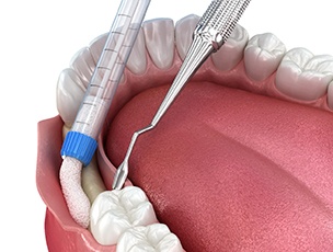 3 D render of a bone graft