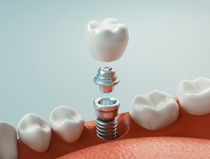 3 D render of a dental implant