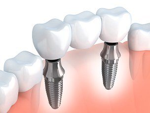 Illustrated dental bridge on two dental implants