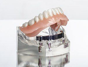 Model of an implant denture