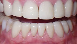 Close up of smile with straight white teeth after dental treatment in Selbyville