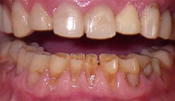 Close up of damaged teeth before treatment from dentist in Selbyville