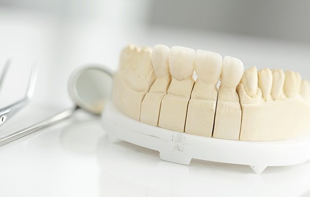 Model of a row of teeth with a dental bridge replacing four consecutive teeth