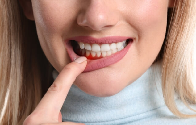 Close up of woman pointing to red spot in her gums