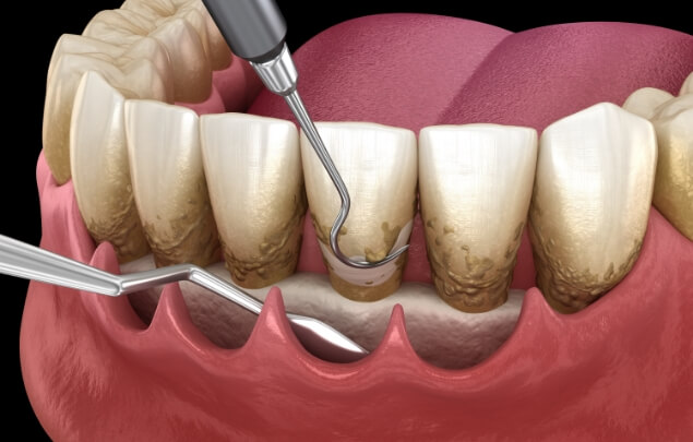 Illustration of gum pockets being cleaned with dental instruments