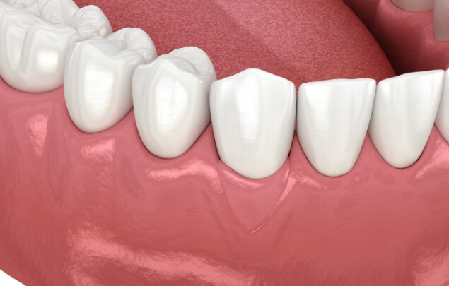 Illustration of gum tissue grafted in front of a tooth