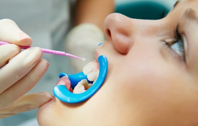 Dental patient having fluoride applied to their teeth