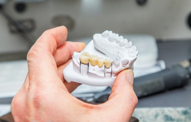 Ceramist creating a dental bridge in a model of a row of teeth