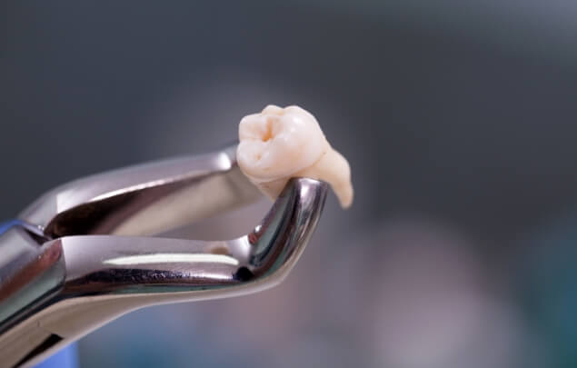 Dental clasp holding an extracted tooth