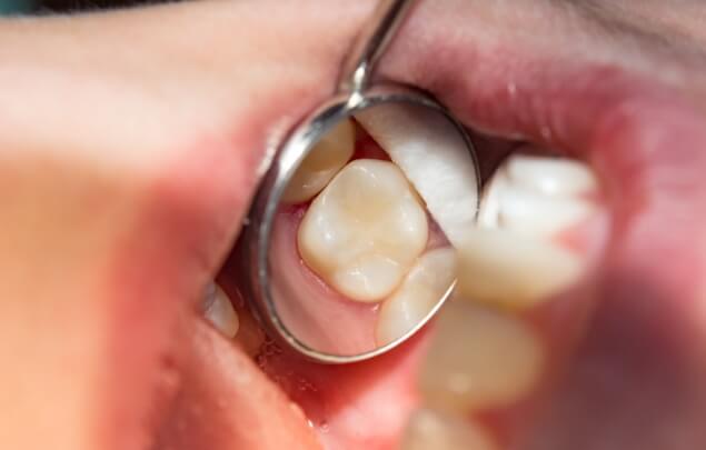 Close up of dental mirror in mouth reflecting a tooth