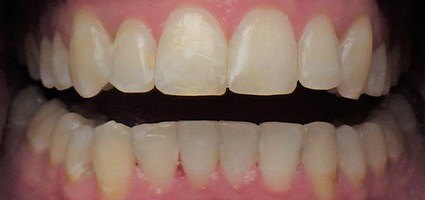 Perfectly straight smile after treatment