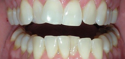 Overlapping and misaligned teeth