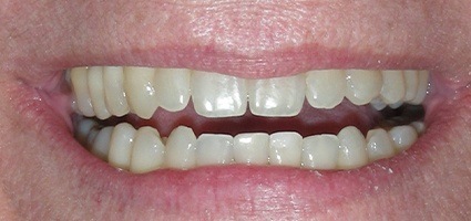 Flawless smile after treatment