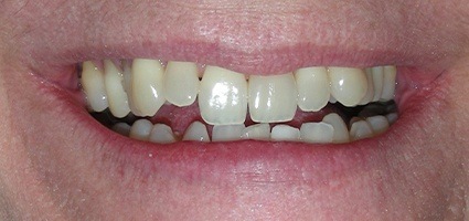 Crooked teeth prior to alignment