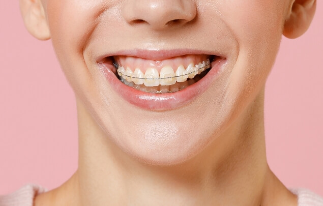 Close up of person smiling with Six Month Smiles