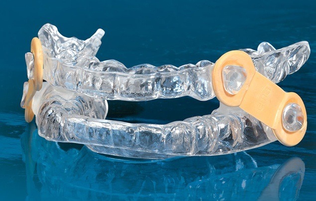 Clear sleep apnea oral appliance