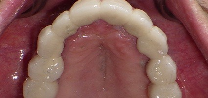 Beautiful smile after telescopic coping bridge placement