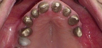 Teeth prepared for telescopic coping bridge placement