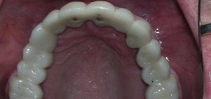 Teeth with telescopic coping bridge restoration