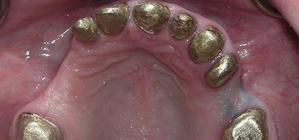 Teeth with telescopic coping bridge preparation in place