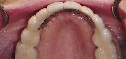 Perfectly restored smile with telescopic coping bridge