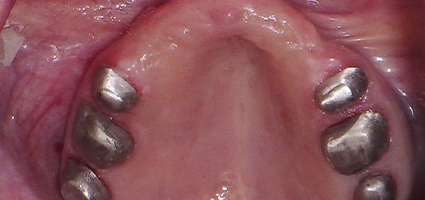 Back teeth with telescopic coping preparation in place