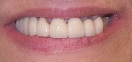 Top teeth replaced with telescopic coping bridge