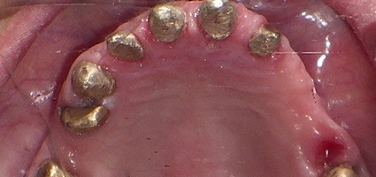 Top teeth prepared for telescopic coping bridge placement