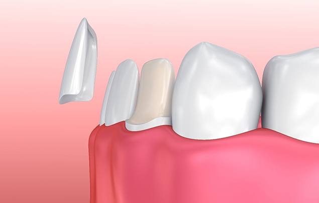 Digital image of a veneer being placed over a natural healthy tooth