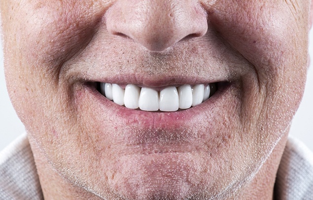 A middle aged man smiling with veneers