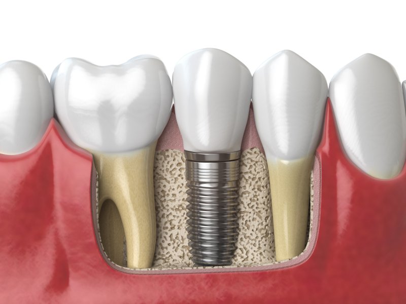 Dental implant